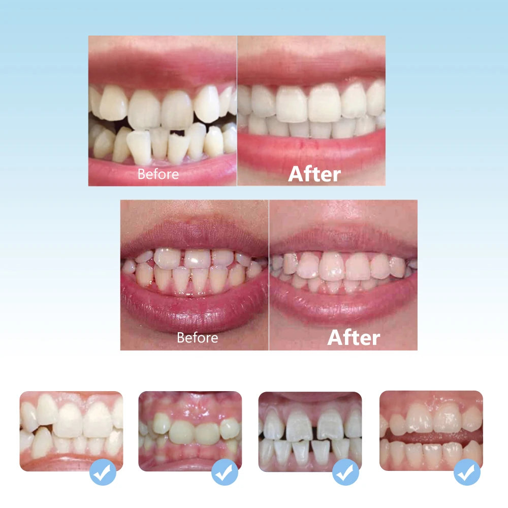 3-Stage Kids Dental Orthodontic Alignment Trainer Set - 12