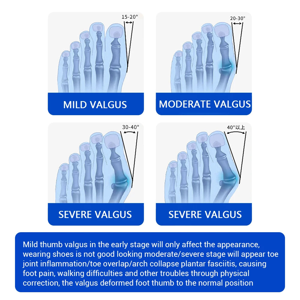 Adjustable Bunion Corrector and Toe Straightener