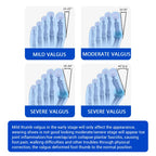 Adjustable Bunion Corrector and Toe Straightener