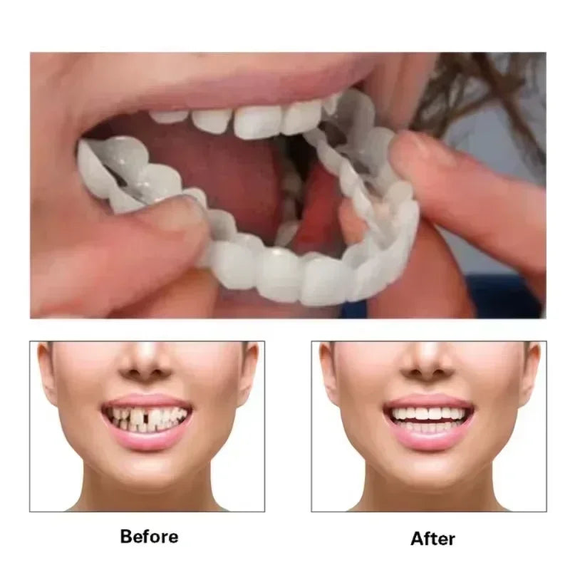 Snap-On Temporary Smile Veneers for Teeth Whitening