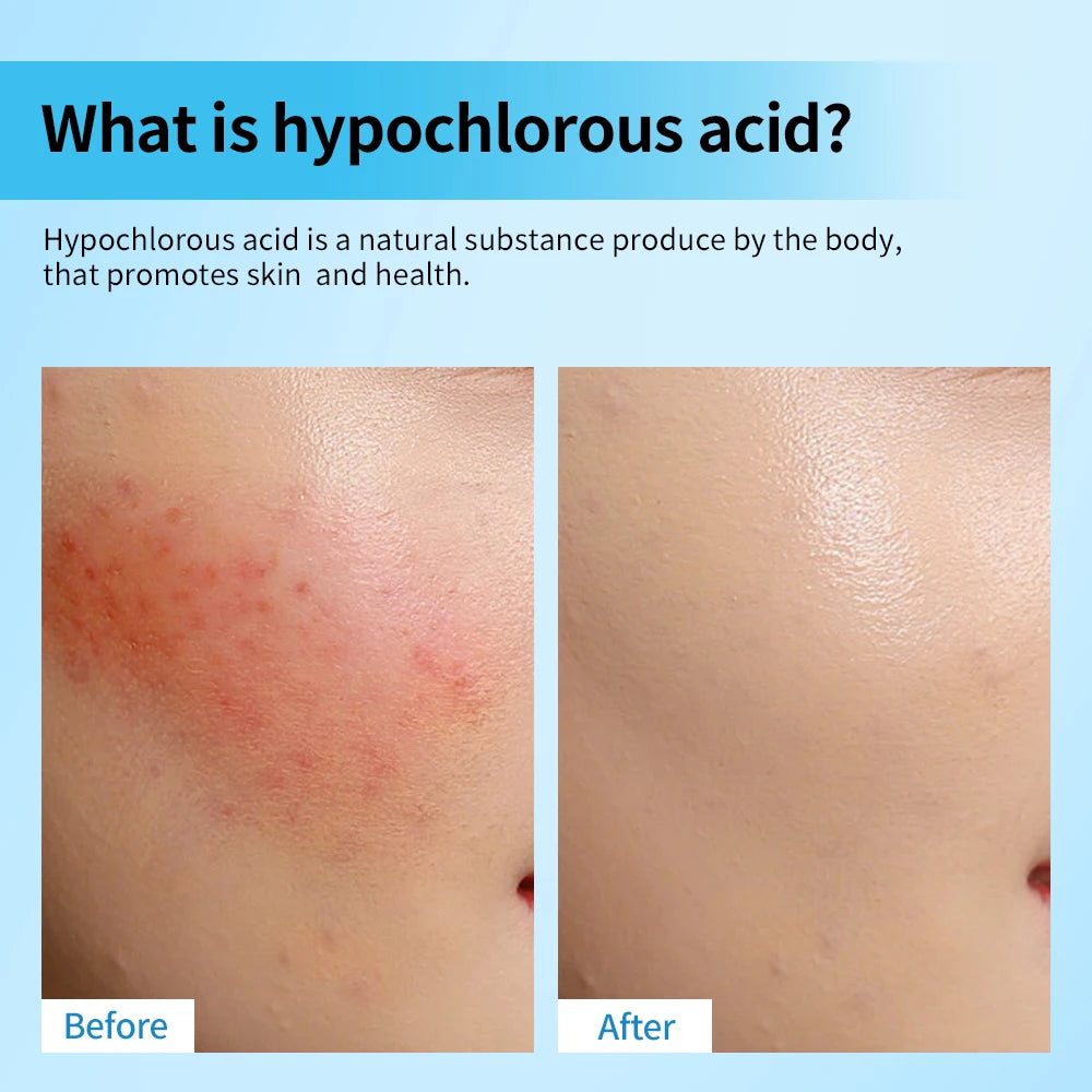 Hypochlorous Acid Facial Spray for Acne and Skin Redness - 4