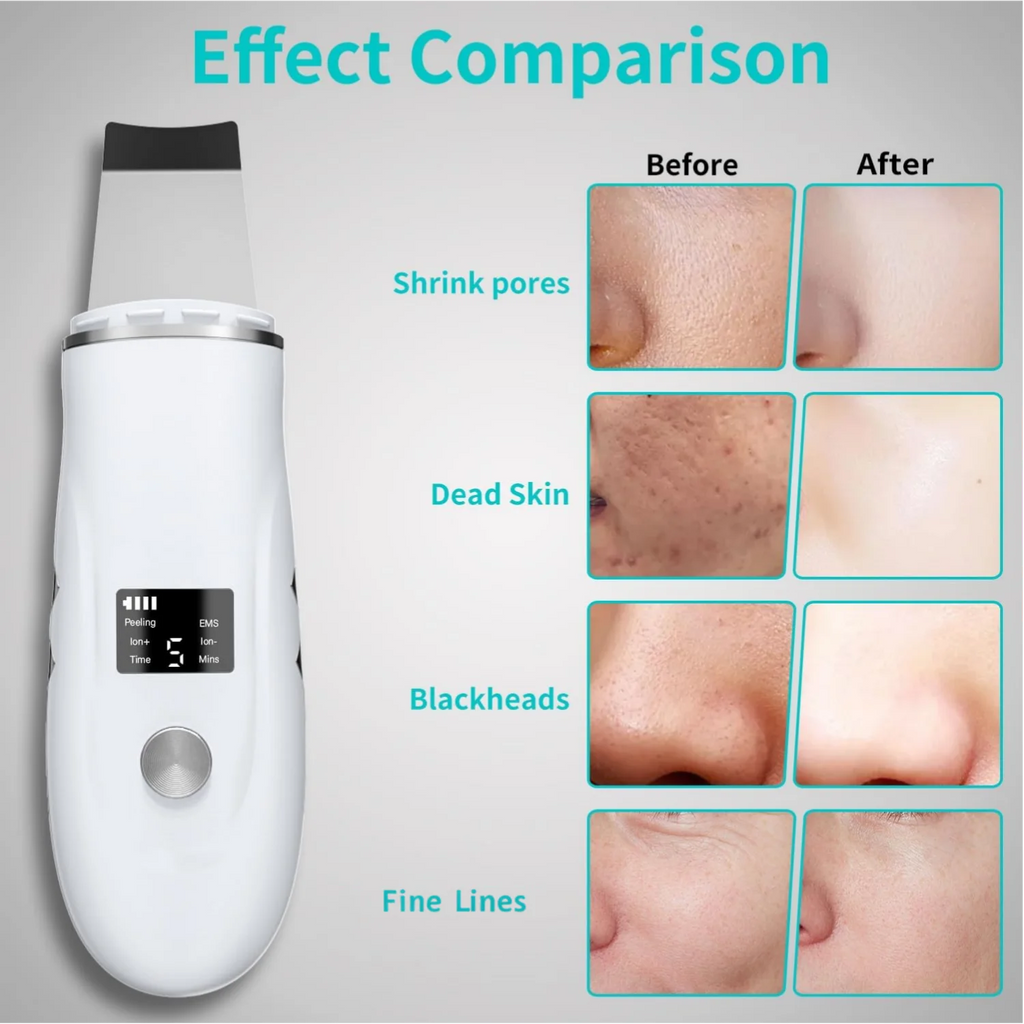 4-in-1 Ultrasonic Facial Skin Scrubber and Pore Cleaner