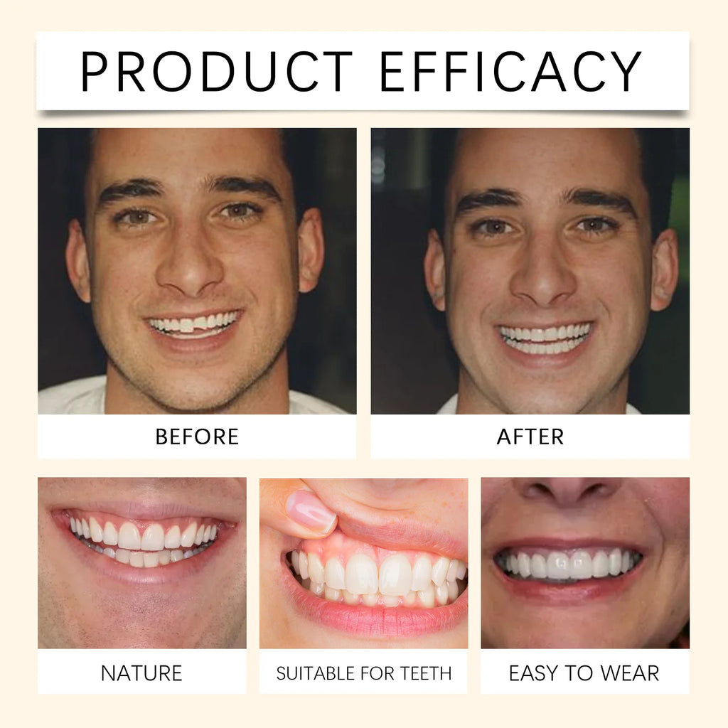 Temporary Silicone Cosmetic Dentures for Smile Improvement