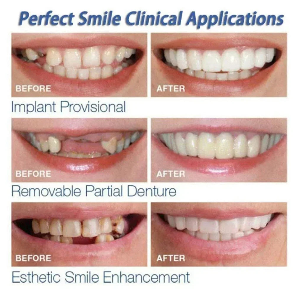 Temporary Snap-On Cosmetic Teeth Veneers Kit