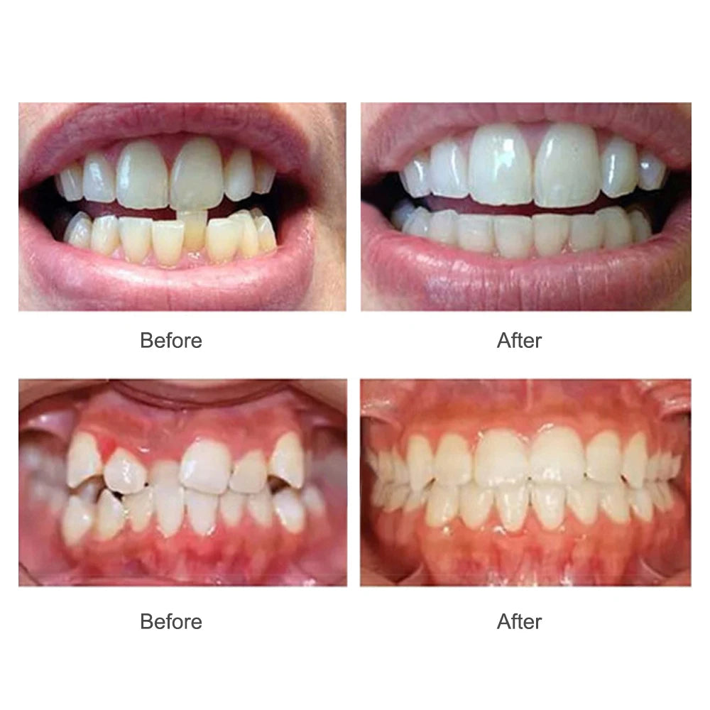 3-Stage Adult Teeth Alignment Orthodontic Trainer Mouthpiece - 6