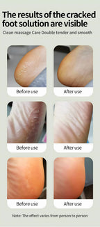Electric Cordless Foot Callus Remover with 6 Speed Settings