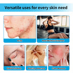 Hypochlorous Acid Facial Spray for Acne and Skin Redness